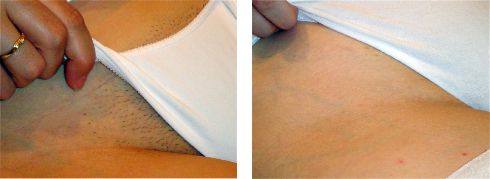 Anus laser hair removal Butt in penis